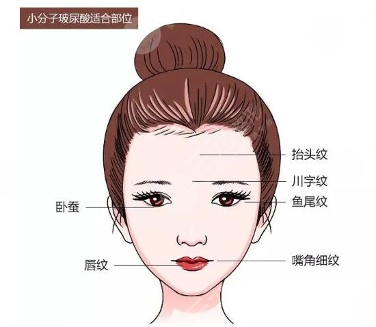 玻尿酸注射|帶你重新認(rèn)識(shí)真正的美顏入門項(xiàng)目！