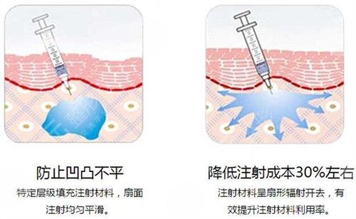 玻尿酸豐臀果怎么樣 玻尿酸豐臀前后果對比圖