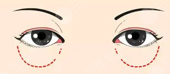 玻尿酸對(duì)淚溝的作用，這道小小的溝壑讓人老5歲！