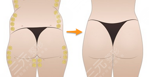 自體脂肪豐臀成好嗎 自體脂肪豐臀多久能夠恢復