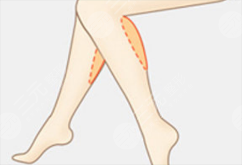 注射,注射瘦臉,瘦腿,見