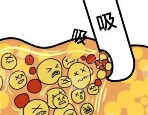 什么是腰腹部吸脂 腰腹部吸脂有后遺癥嗎 什么是腰腹部吸脂 腰腹部吸脂有后遺癥嗎