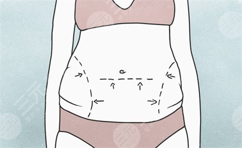 腰腹部,吸脂,后遺癥
