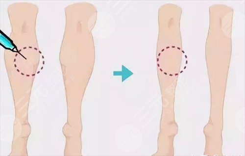 注射瘦臉瘦小腿多久注射一次 注射瘦臉瘦小腿多久注射一次