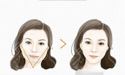 面部吸脂后多久消腫 面部吸脂后多久消腫