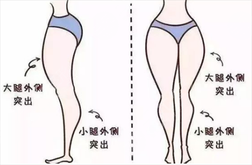 大腿吸脂手術(shù)有什么優(yōu)點(diǎn) 大腿吸脂手術(shù)后會(huì)留疤嗎 大腿吸脂手術(shù)有什么優(yōu)點(diǎn) 大腿吸脂手術(shù)后會(huì)留疤嗎