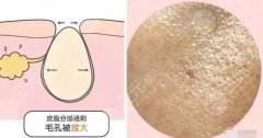 什么辦法可以讓毛孔縮??？需要改良毛孔粗大可以學(xué)習(xí)一下
