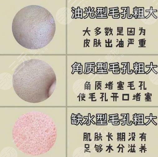 什么辦法可以讓毛孔縮小