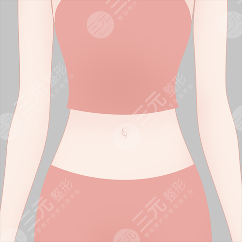 腹部,吸脂,影響,生育