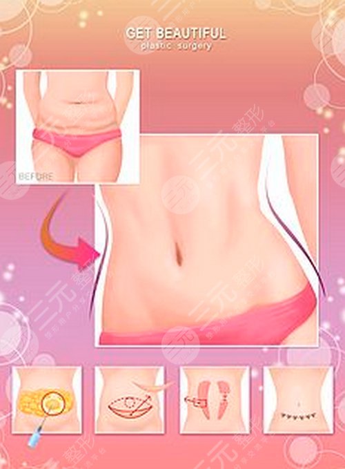 腹部吸脂后穿多久塑身衣