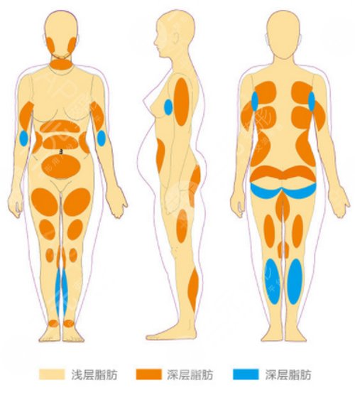 腹部吸脂會不會反彈