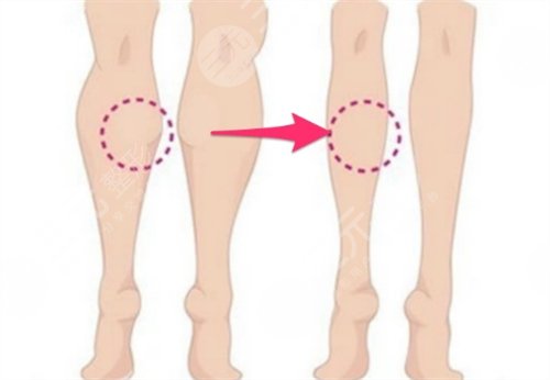 脂肪減少瘦小腿降低風險嗎，多少錢？科普講解瘦腿秘訣！