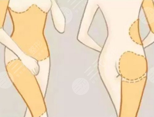 等離子激光溶脂副作用