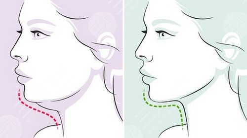 光纖溶脂瘦臉恢復過程圖