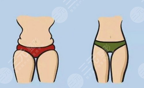 溶脂手術(shù)成好嗎