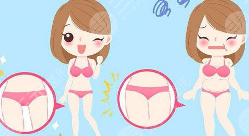 吸脂手術(shù)以后怎么護(hù)理