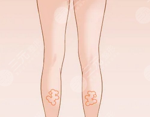 rd素瘦小腿身體塑形