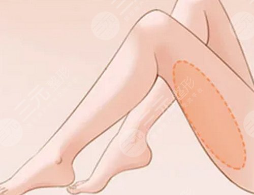 術(shù)前了解！瘦小腿抽脂可能會引發(fā)的副作用