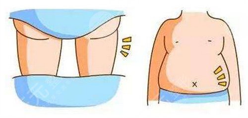 抽脂以后注意事項