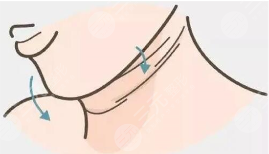 嗨體去頸紋有什么副作用？多久可以看到果？恢復(fù)期注意事項(xiàng)學(xué)起來~
