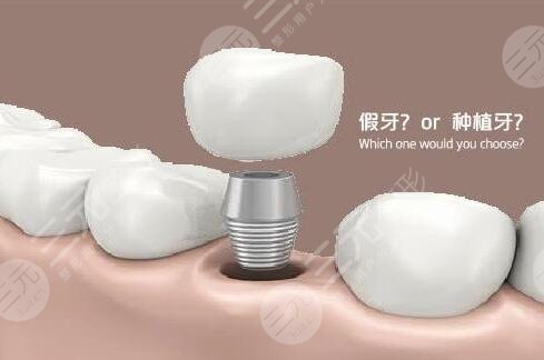 花都區(qū)人民醫(yī)院種牙案例