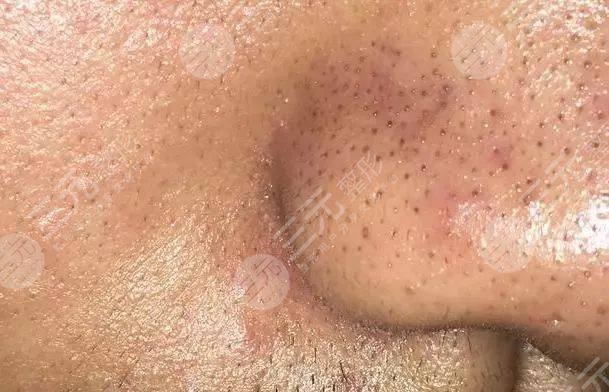 收縮毛孔的4大常見誤區(qū)