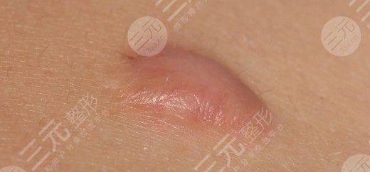 <b>增生性疤痕</b>