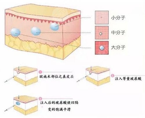 注射玻尿酸除皺有什么弊端