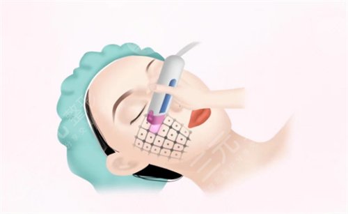 飛梭鐳射和點陣激光的區(qū)別是什么？選哪個好些？