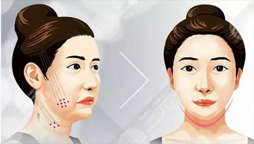 熱瑪吉新一代有1200發(fā)嗎？超熱門(mén)的醫(yī)美抗衰項(xiàng)目為你剖析！