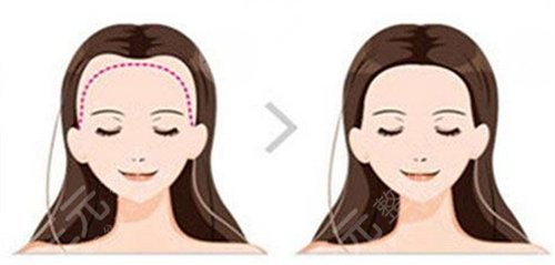 毛發(fā)移植的全過程