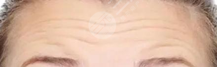 美女和媽媽玻尿酸除皺案例分享