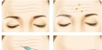 射頻除皺的知識普及