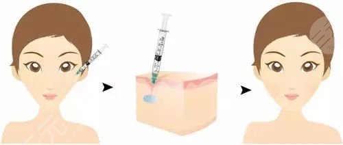 注射法除皺術(shù)怎么樣 注射法除皺術(shù)有什么特點