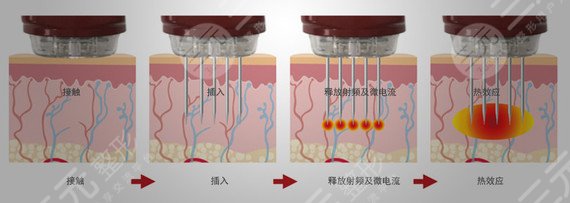 黃金微針有哪些禁忌癥?