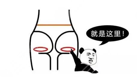 激光去臀印要多久才有？科普介紹！美臀指南帶你了解~