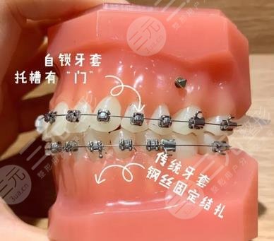 牙齒矯正過(guò)程