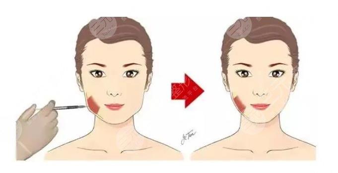 注射瘦臉術(shù)前要做好什么準備