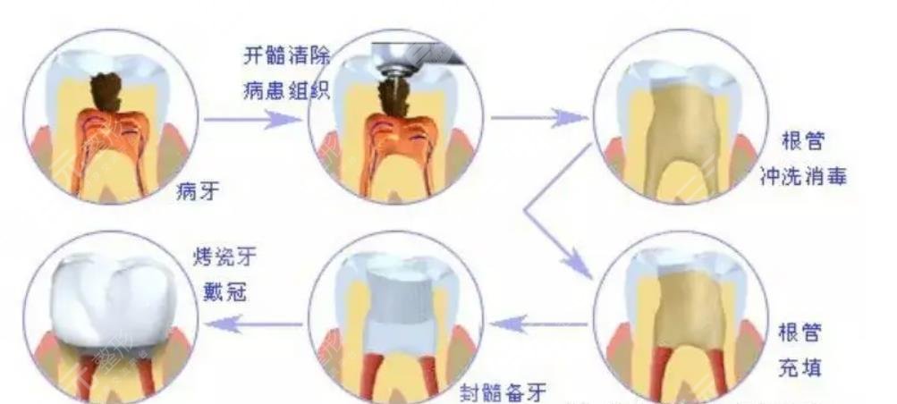 根管緩解多少錢一顆牙?價(jià)格差別為什么這么大?