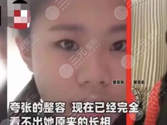 13歲開(kāi)始整容女現(xiàn)狀如何?1