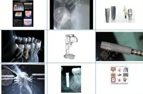 德國費亞丹種植體