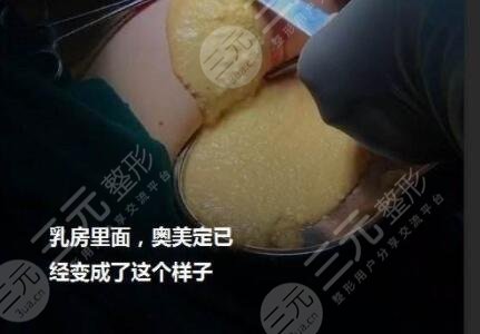 取奧美定可以醫(yī)保報銷嗎？