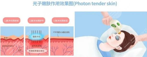 光子嫩膚作用果