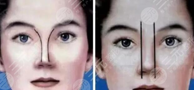 假體隆鼻術(shù)后3天