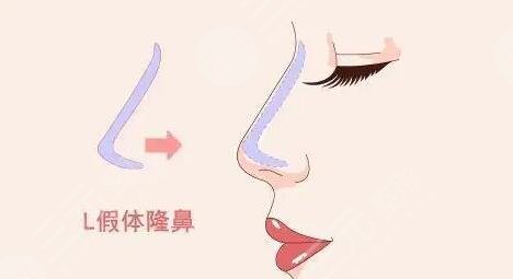 假體隆鼻術(shù)后5天