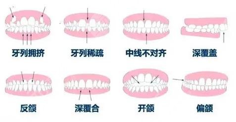 牙齒矯正適應癥