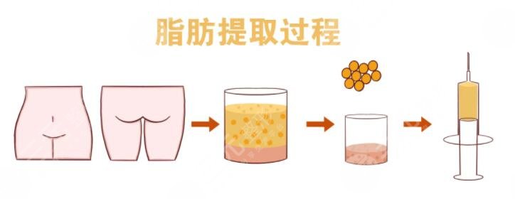 全臉脂肪填充術(shù)前要注意什么