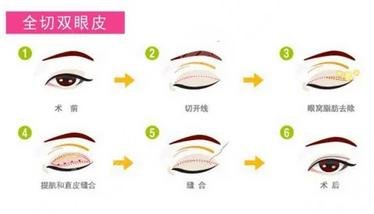 全切雙眼皮過程