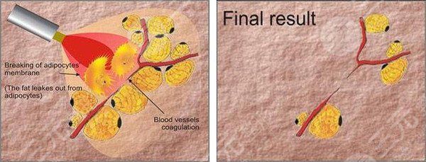 腿部吸脂有什么后遺癥
