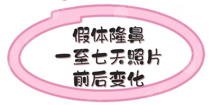 假體隆鼻一至七天照片前后變化
